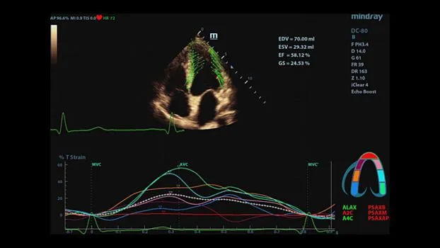 Клинические изображения УЗИ аппарат Mindray DC-80 X-insight