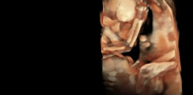 Клинические изображения УЗИ аппарат GE HealthCare Voluson Expert 22