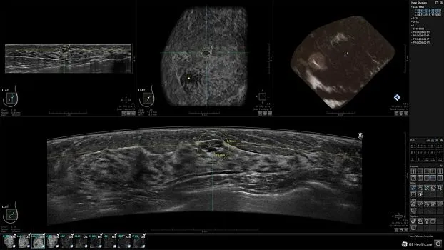 Клинические изображения GE HealthCare Invenia ABUS ультразвуковая система