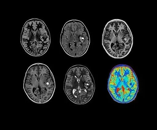 Клинические изображения МРТ аппарат GE SIGNA Architect 3T