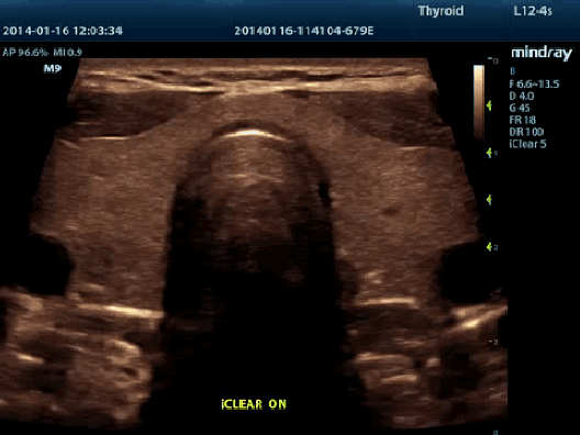 Клинические изображения УЗИ аппарат Mindray M9 портативный