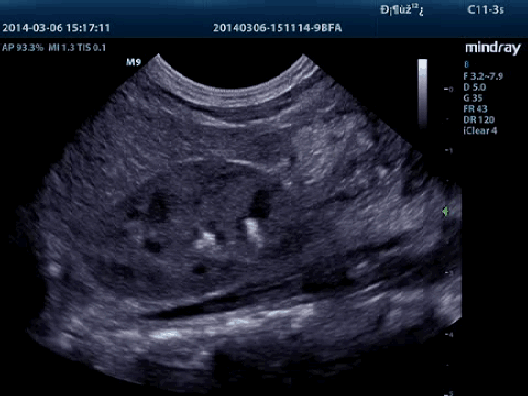 Клинические изображения УЗИ аппарат Mindray M9 портативный