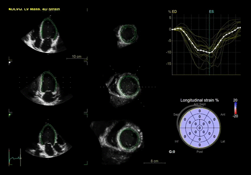 Клинические изображения Ультразвуковая диагностическая система GE HealthCare Vivid E95