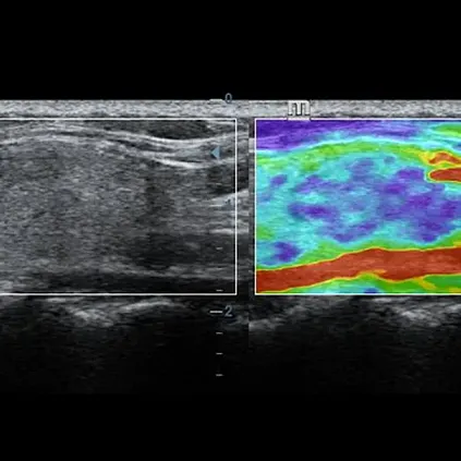 Клинические изображения УЗИ аппарат Mindray DC-40 Pro
