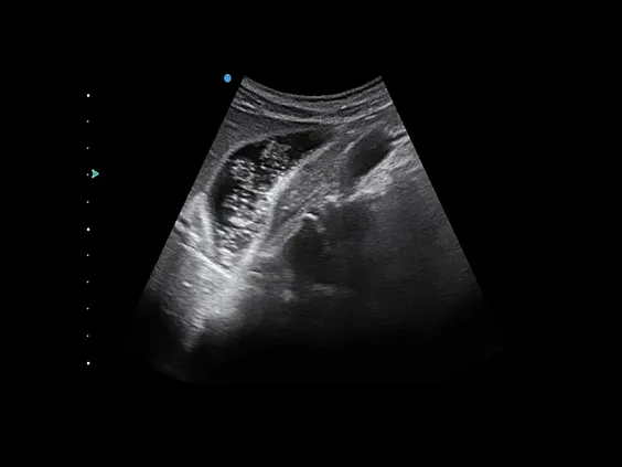 Клинические изображения Аппарат УЗИ SIUI Apogee 3500
