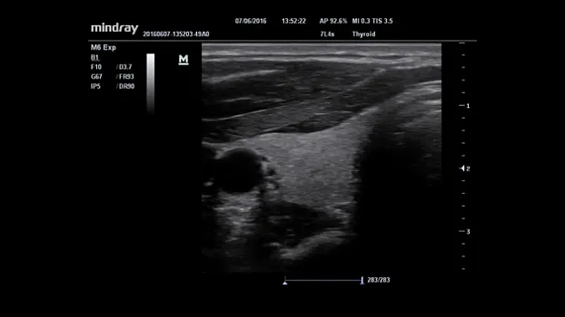 Клинические изображения УЗИ аппарат Mindray M6 портативный