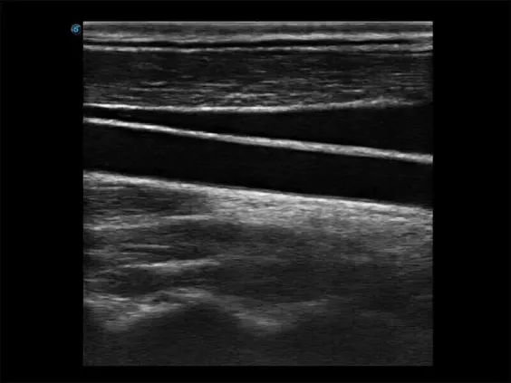 Клинические изображения Sonoscape E3 ультразвуковой аппарат