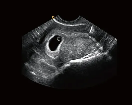 Клинические изображения УЗИ аппарат Chison Qbit 7