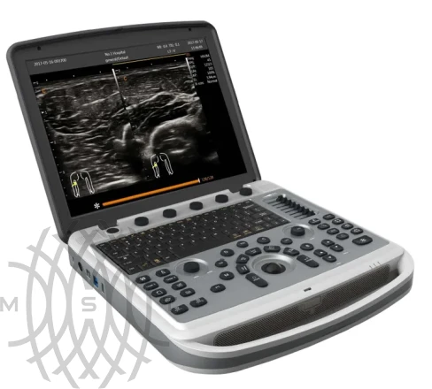 УЗИ аппарат Chison SonoTouch 80 портативный