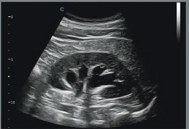 Клинические изображения УЗИ аппарат Chison Qbit 11