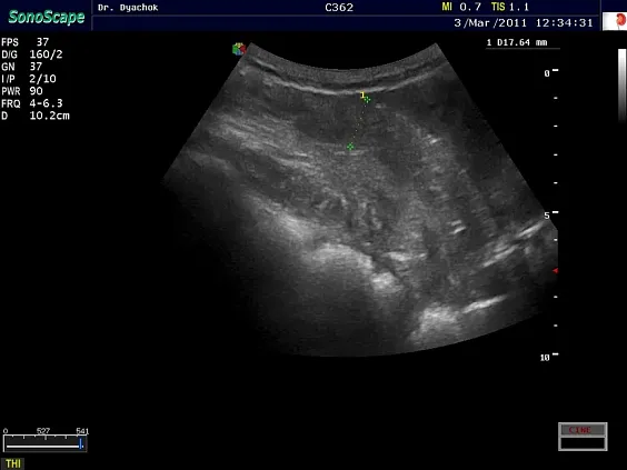 Клинические изображения Sonoscape S30 ультразвуковой аппарат