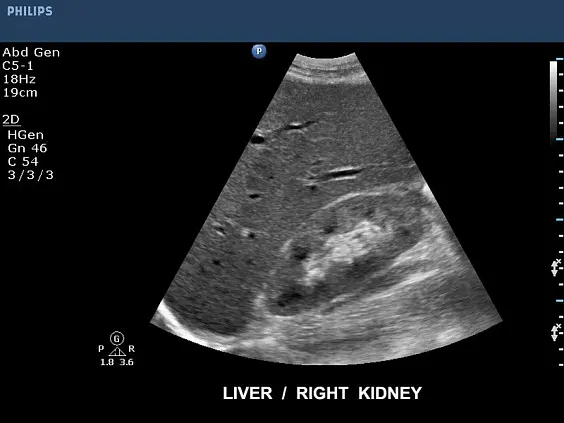 Клинические изображения Philips CX50 ультразвуковой аппарат
