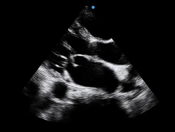 Клинические изображения Аппарат УЗИ SIUI Apogee 5500