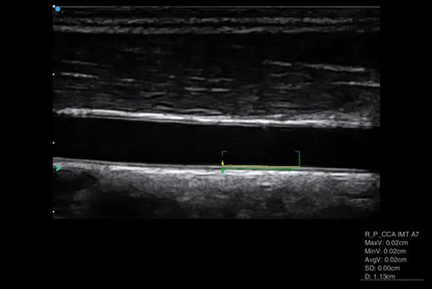 Клинические изображения SIUI Apogee 5300 аппарат УЗИ
