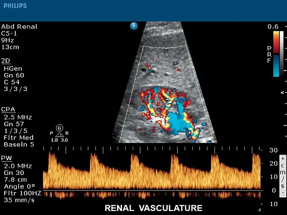 Клинические изображения Philips CX50 ультразвуковой аппарат