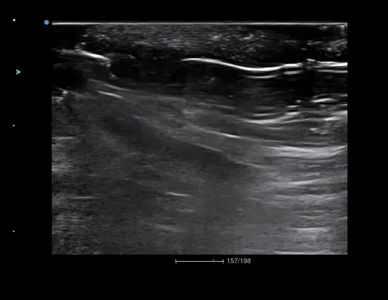 Клинические изображения SIUI Apogee 6500 ультразвуковой аппарат