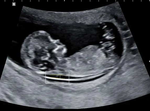 Клинические изображения УЗИ аппарат НПО СКАНЕР РУСКАН 65М