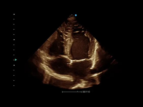 Клинические изображения Аппарат УЗИ SIUI Apogee 3500