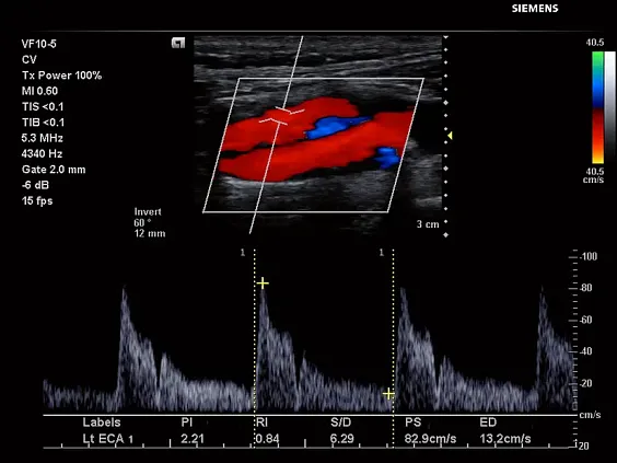Клинические изображения Siemens Acuson P500 портативный аппарат УЗИ