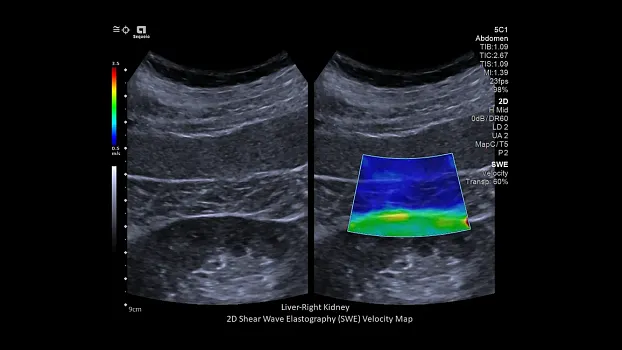 Клинические изображения Siemens Sequoia аппарат УЗИ