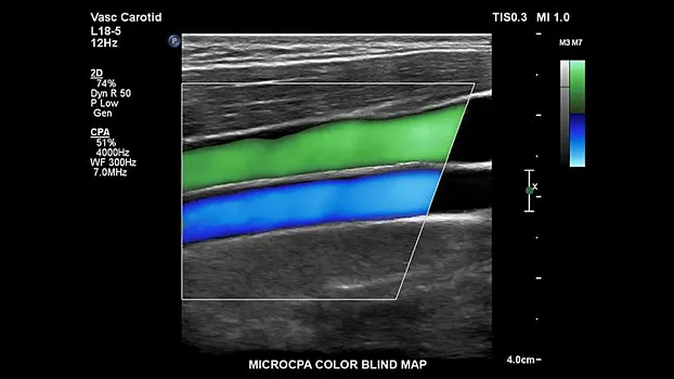 Клинические изображения Philips EPIQ 5 ультразвуковой аппарат