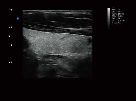 Клинические изображения Chison Qbit 3 аппарат УЗИ