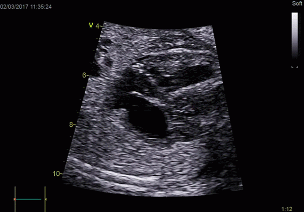 Клинические изображения УЗИ аппарат GE HealthCare Vivid E90