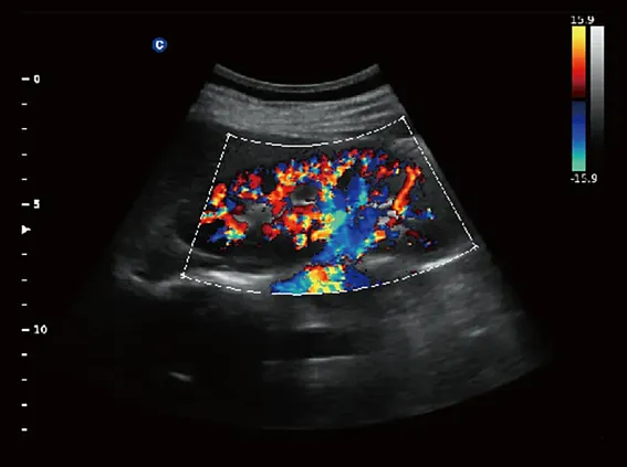 Клинические изображения Chison Qbit 3 аппарат УЗИ