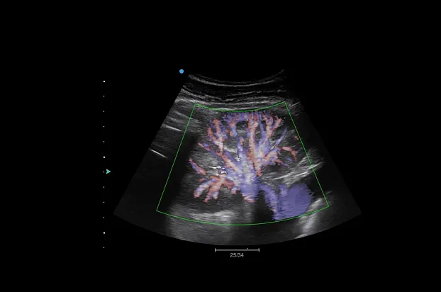 Клинические изображения SIUI Apogee 5300 аппарат УЗИ