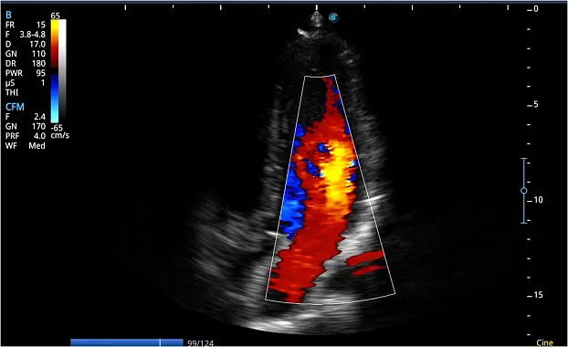 Клинические изображения Sonoscape E2 ультразвуковой аппарат