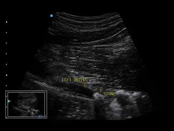 Клинические изображения Аппарат УЗИ SIUI Apogee 5500
