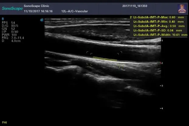 Клинические изображения Sonoscape E2 ультразвуковой аппарат