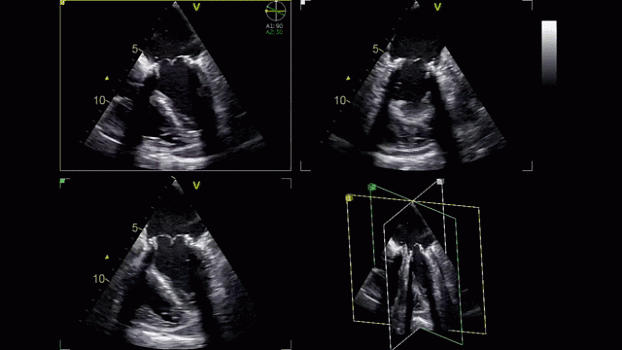 Клинические изображения Ультразвуковая диагностическая система GE HealthCare Vivid iQ портативная