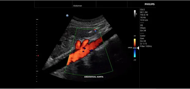 Клинические изображения Philips InnoSight ультразвуковой аппарат