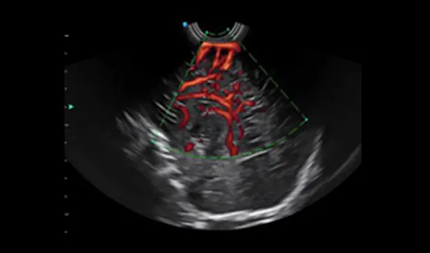 Клинические изображения SIUI Apogee 6500 ультразвуковой аппарат