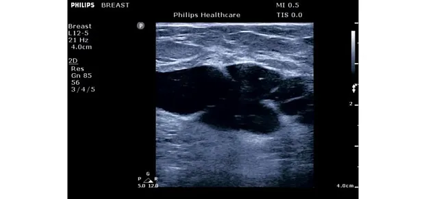 Клинические изображения Philips ClearVue 650 ультразвуковой аппарат