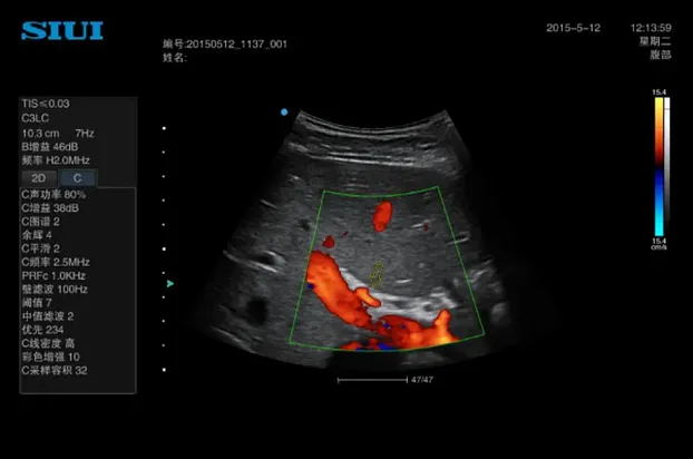 Клинические изображения Аппарат УЗИ SIUI Apogee 3500