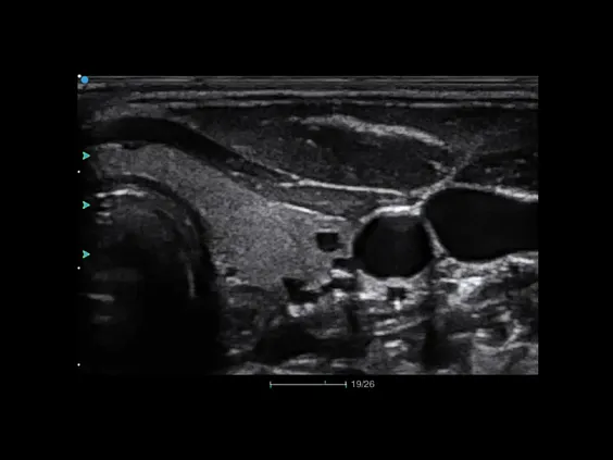 Клинические изображения Аппарат УЗИ SIUI Apogee 3500