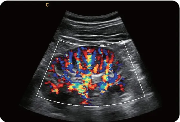 Клинические изображения УЗИ аппарат Chison Qbit 9 New Matrix