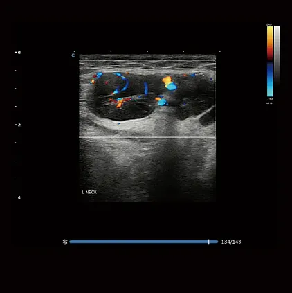 Клинические изображения Chison Qbit 12 ультразвуковой аппарат